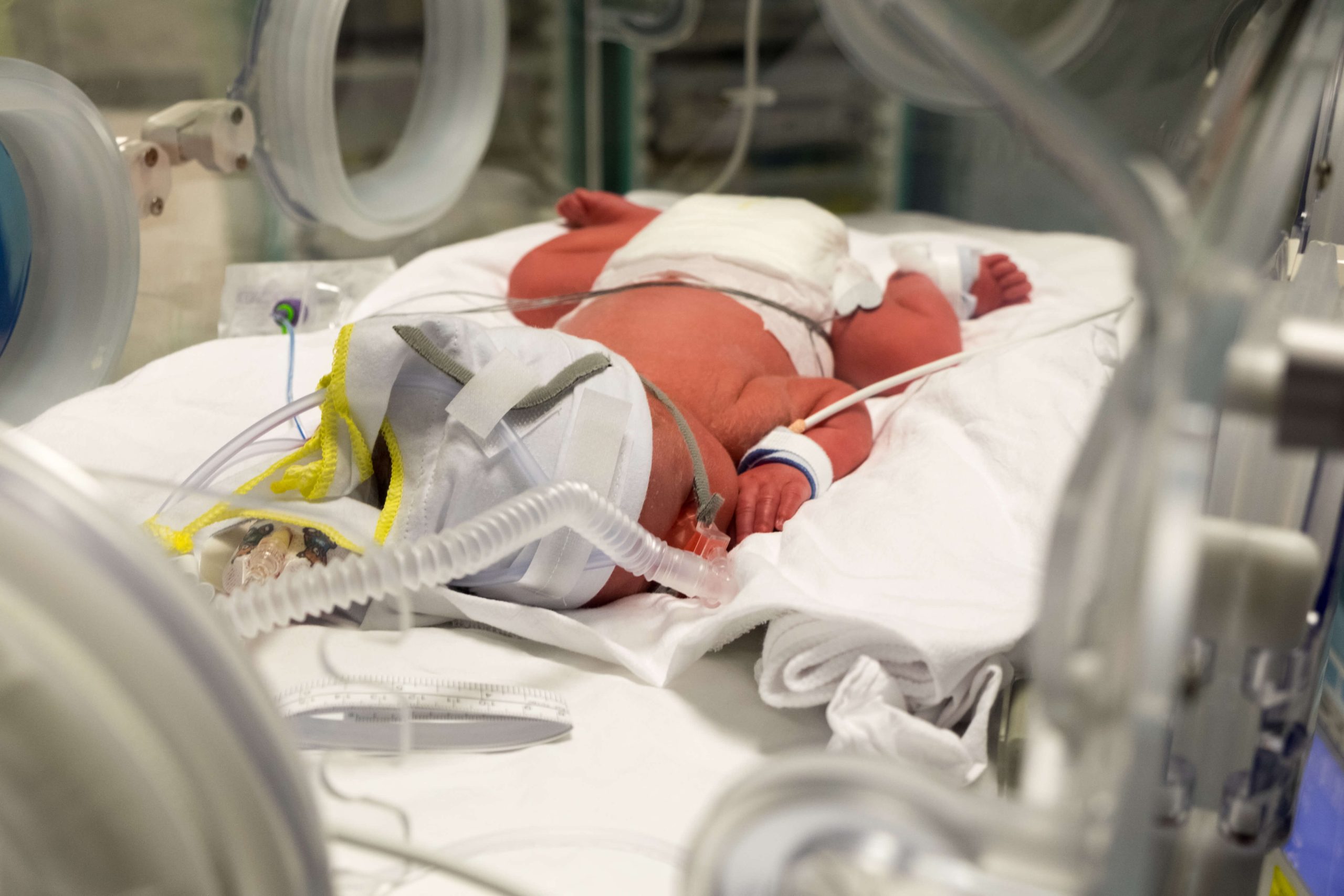 baby with a birth injury in the NICU