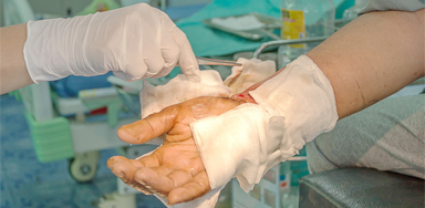 Medical staff putting dressing on the burned wound of a burn victim - second-degree burns