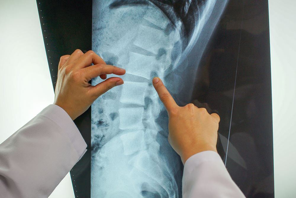 A doctor examining an X-Ray to determine the cause of a patient's spinal injury.